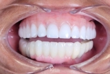 Choosing the Best: How To Select A Dental Implant Specialist